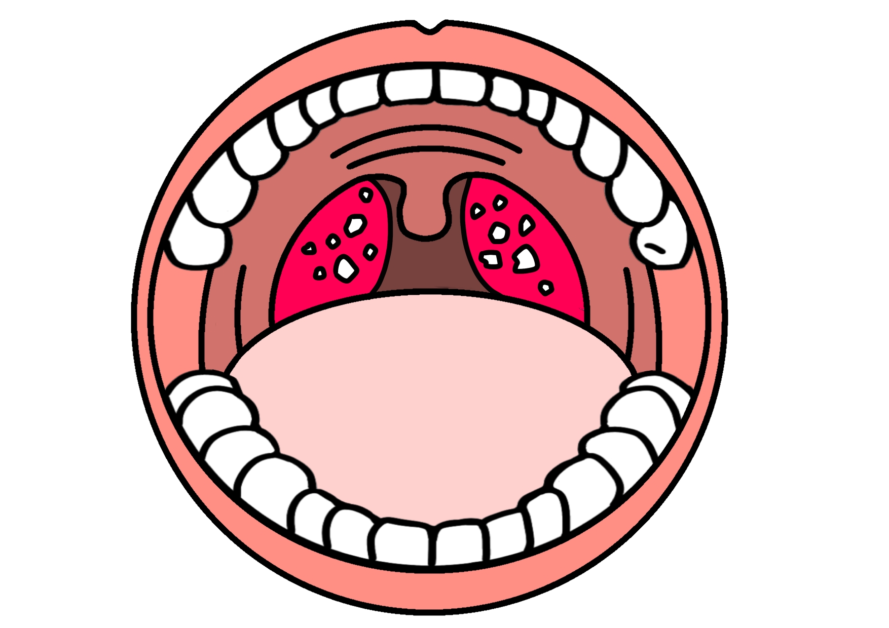 扁桃腺炎の症状と治療方法｜腫れ 高熱 白い - 扁桃腺＋HealthCare